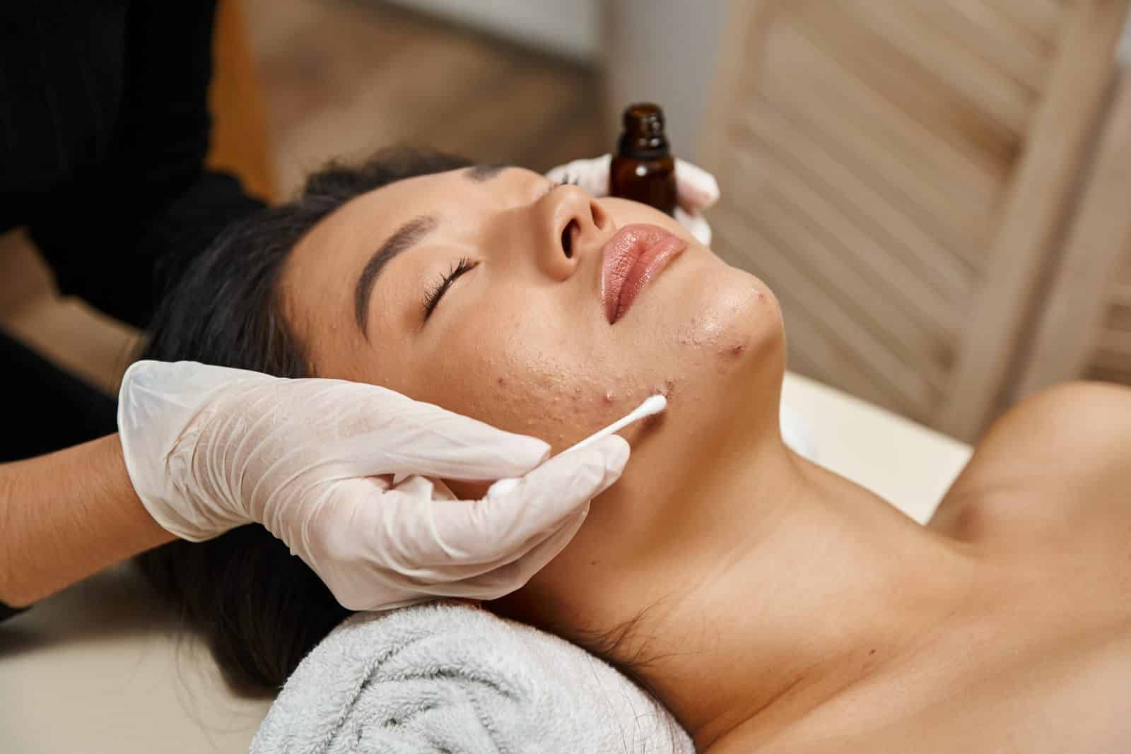 Soins anti-acné